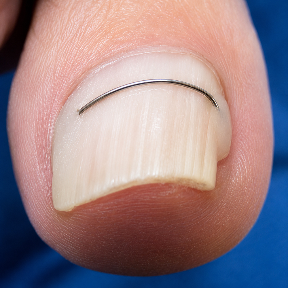Ongle